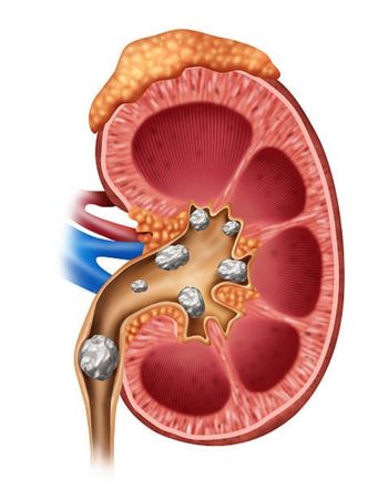 AYURVEDIC KIDNEY TREATMENT IN FAIZABAD